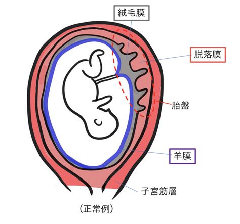 胎盤形成出血|【医師監修】妊娠中に出血を伴う症状、絨毛膜下血腫。